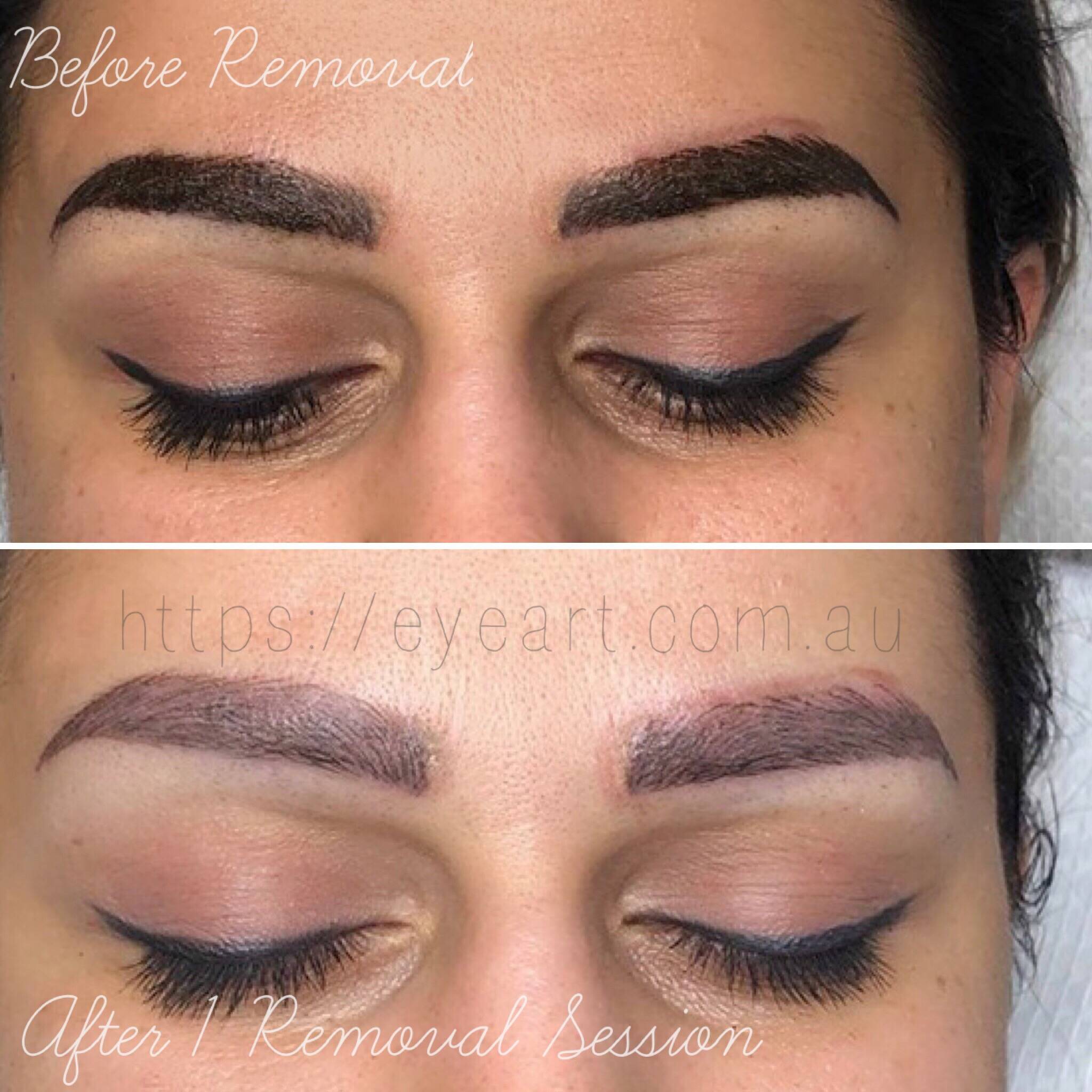 Eyebrow Tattoo Removal Microblading Removal Non Laser