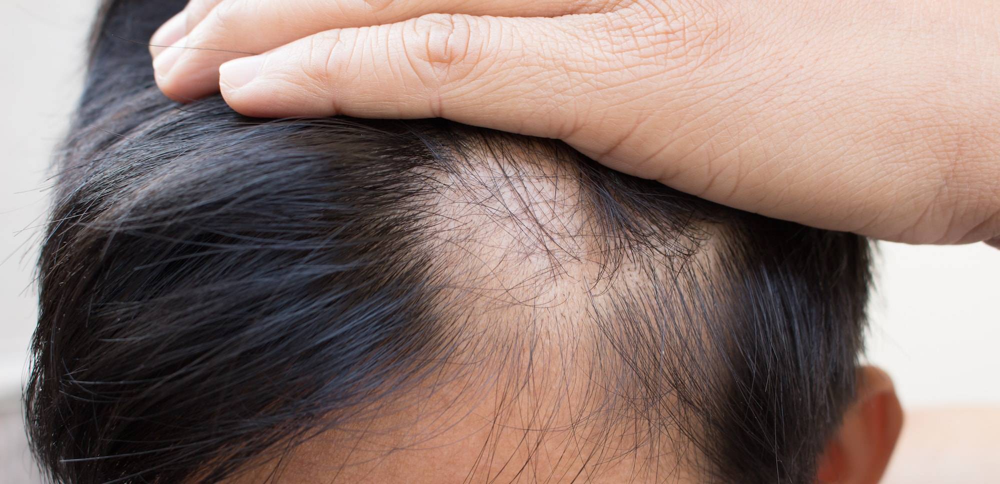 Can Androgenic Alopecia Be Reversed? – DS Healthcare Group