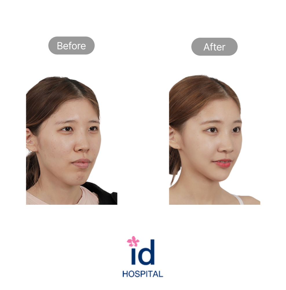 No-Tie Double Jaw Surgery, High-L Zygoma Reduction, and Protruding Mouth Surgery Before and After at ID Hospital