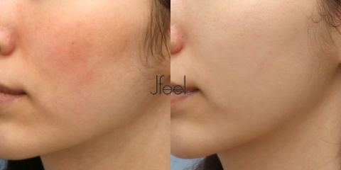 Rosacea Laser Treatment in Korea Showing Facial Redness Reduction Results