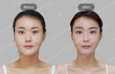 Orthognathic Surgery and Facial Contouring Revision Before and After Results in Korea Featuring Cheekbone Reduction, Square Jaw Revision, and Balanced Facial Proportions