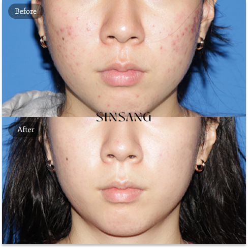 Acne Treatment Before and After Results at a Korean Dermatology Clinic