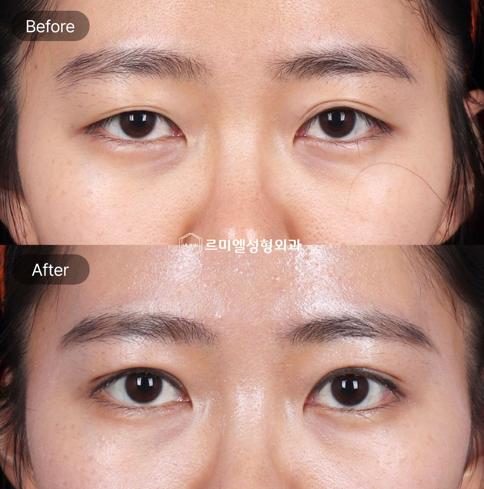 Before and After Results of Non Incisional Ptosis Correction After One Month