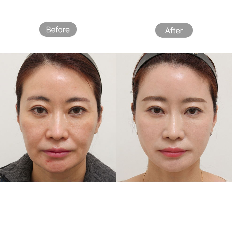 Facial contouring before and after results for jawline and face slimming at Fresh Dr. Hong in Korea