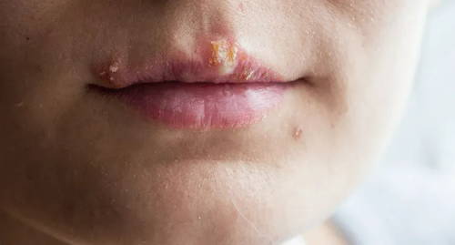 The lower half of someone’s face with a honey-colored crusty blister from impetigo on their upper lip