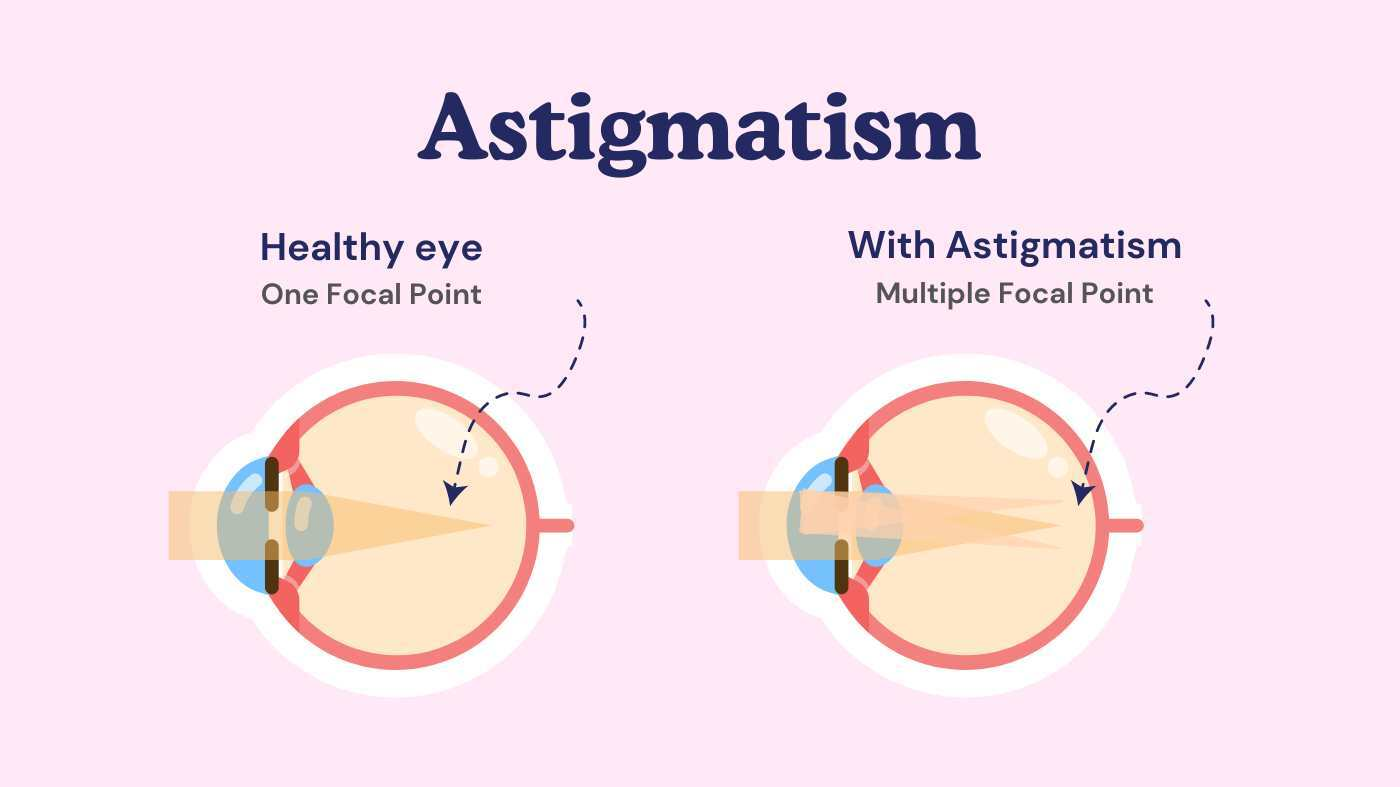 Understanding Astigmatism
