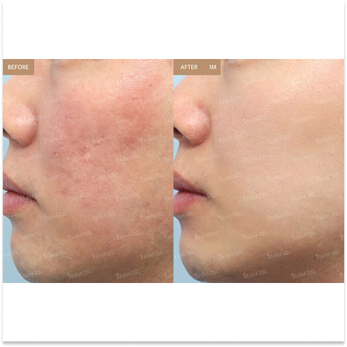 Juvelook Skin Booster for Korean Summer Skin Treatments Targeting Acne Scars, Redness, and Pigmentation in Seoul
