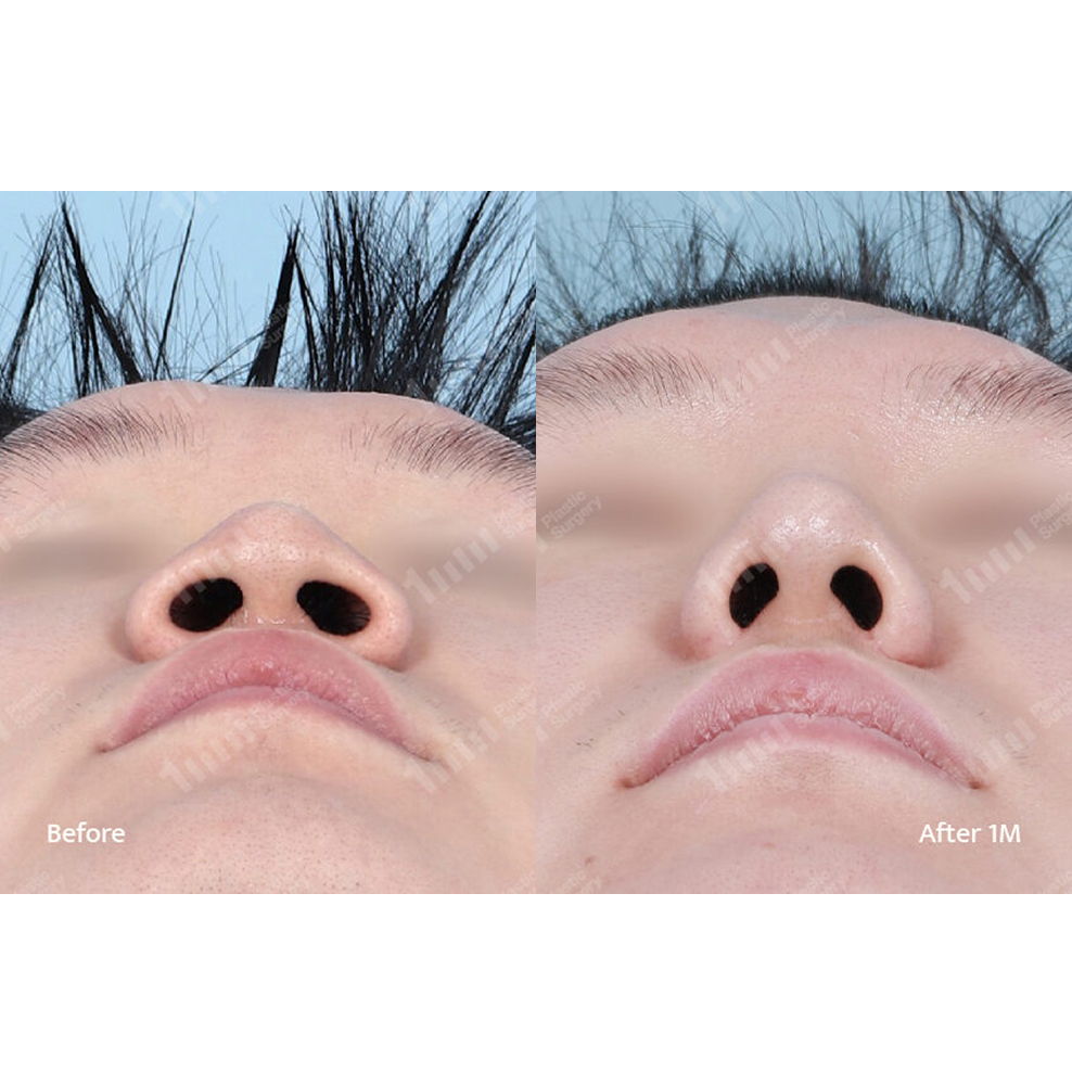 Male Rhinoplasty and Alar Reduction Bottom View Before and After Results at 1MM Plastic Surgery in Korea