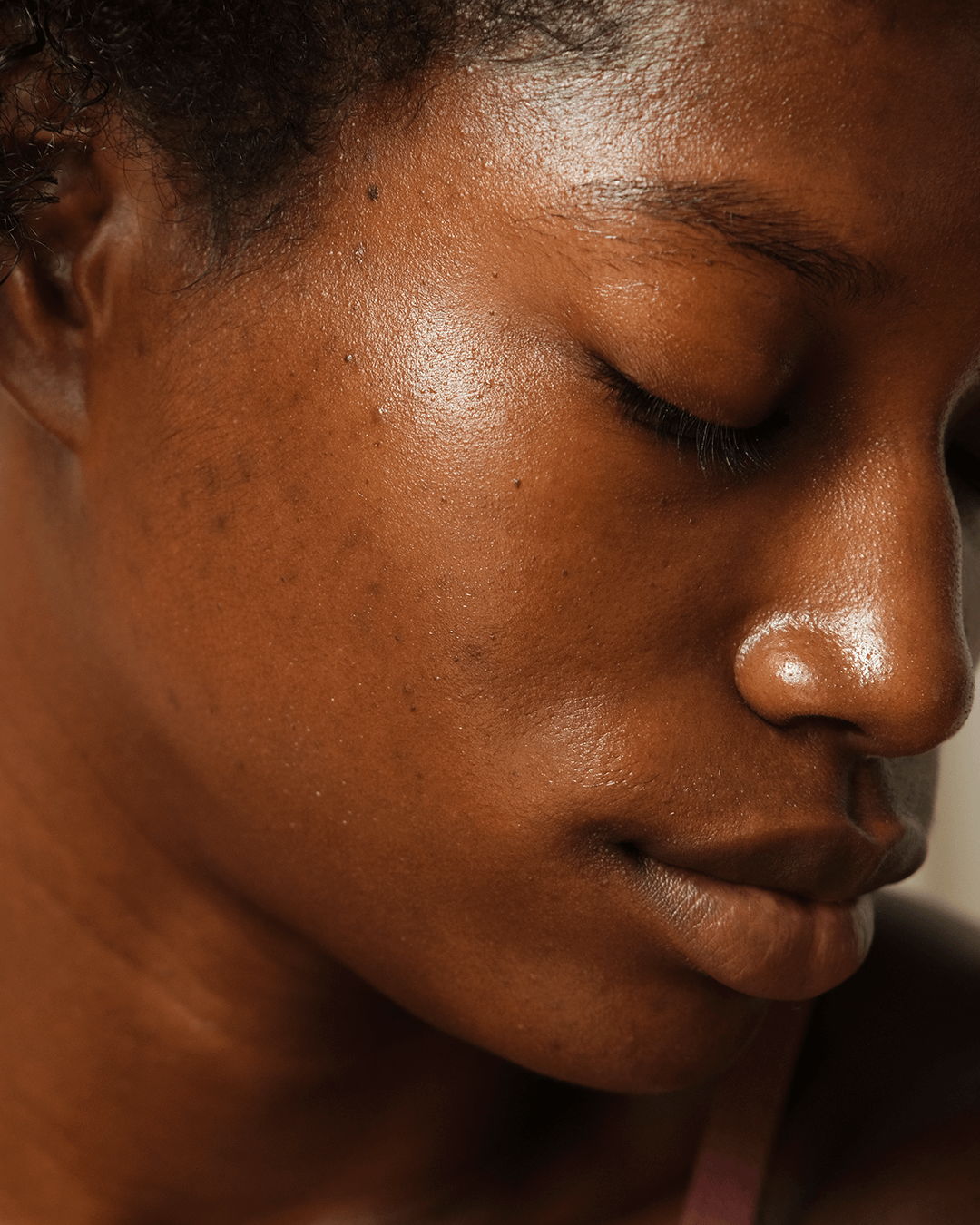 #seo: acne-prone skin
