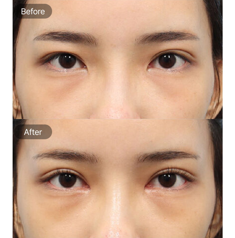 Incisional Double Eyelid Revision Surgery and Epicanthoplasty Before and After Results at 1MM Plastic Surgery in Korea