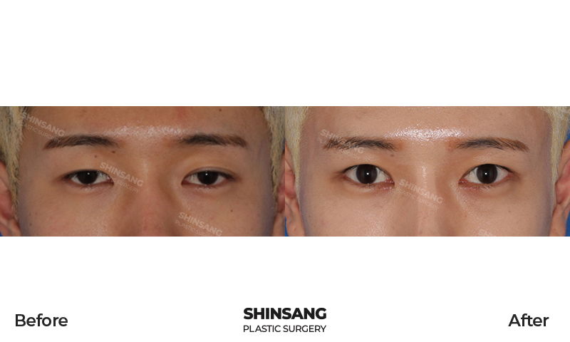 Incisional Double Eyelid Surgery With Epicanthoplasty Lateral Canthoplasty And Ptosis Correction Result At Sinsang Plastic Surgery In Korea