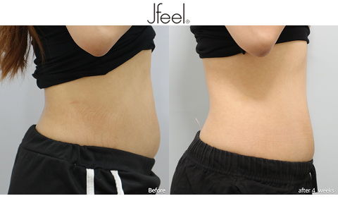 Noninvasive Liposuction Abdominal Body Fat Reduction Before and After Results After 4 Weeks