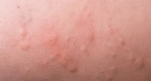 Erhabene Beulen und für Nesselsucht typische gerötete Haut, was ein Allergiesymptom sein kann