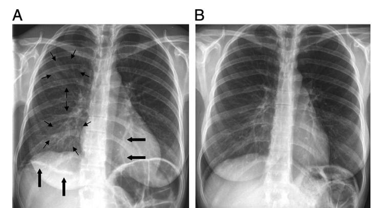 Covid 19 Chest X Ray Guideline Ucla Radiology Los Angeles