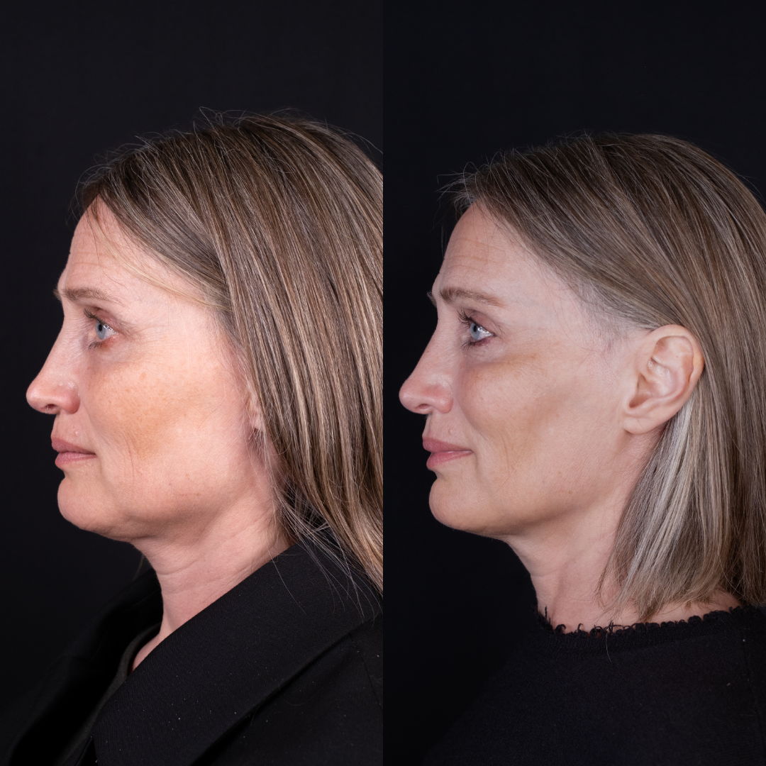 Profile comparison of a woman with different hairstyles and lighting.