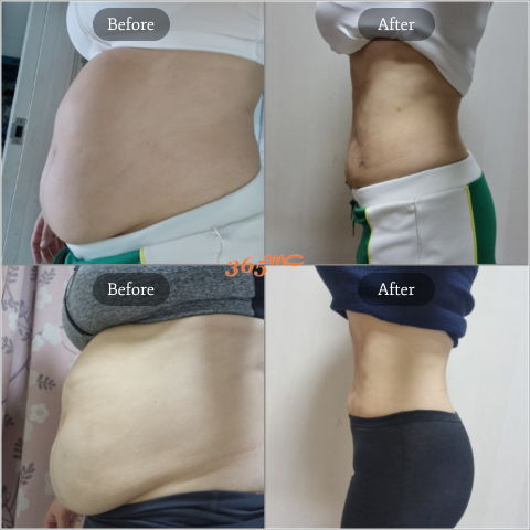 Before And After Results Of Fat Dissolving Injection LAMS For Body Fat Reduction In Korea