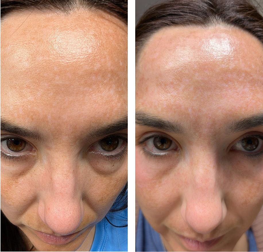 Close-up of a woman's forehead before and after treatment.