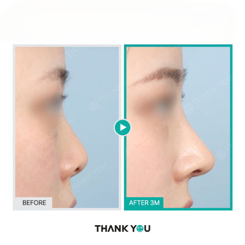 Plastic Surgery Recovery Timeline at 3 Months Showing Stabilized Healing and Refined Results After Surgery