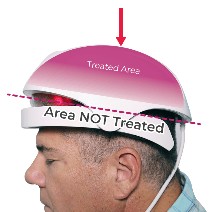 iRestore helmet partial coverage