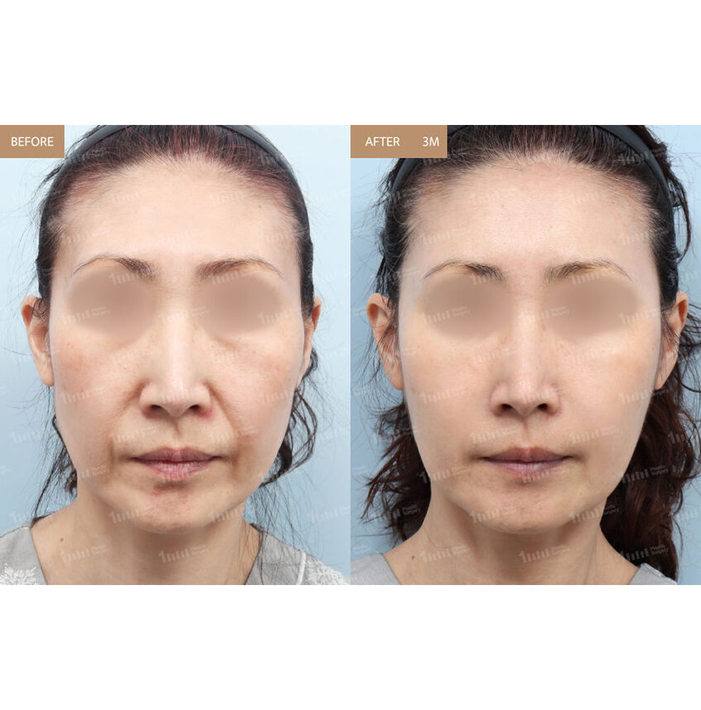Midlife Women Full Face Fat Grafting Before and After Results at 1MM Plastic Surgery in Korea for Natural Facial Rejuvenation