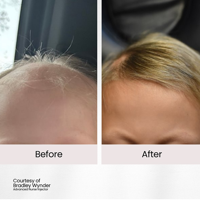 hair restoration after cancer treatment