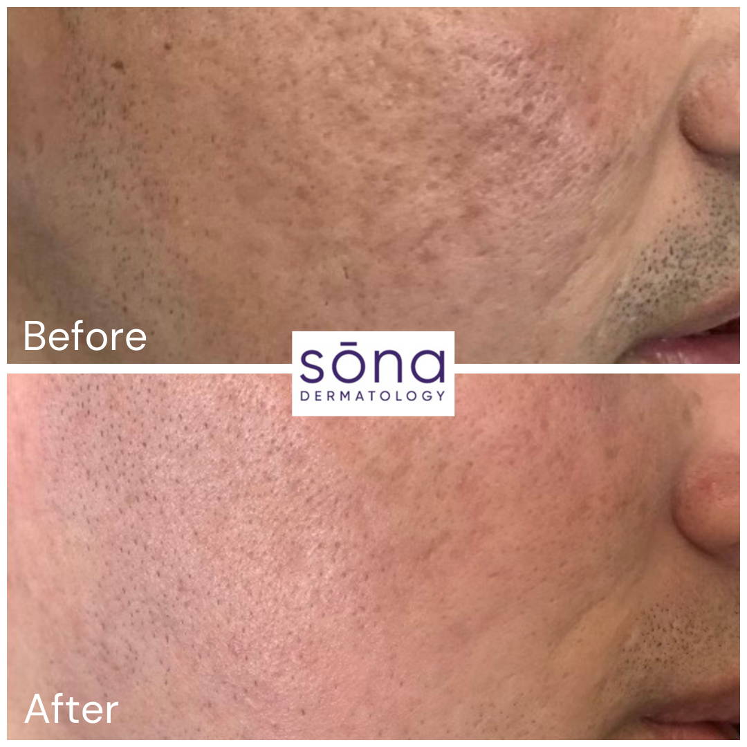 Sona SkinPen Before & After 2