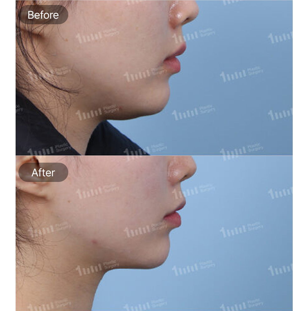 Shurink Lifting Before and After Results at 1MM Plastic Surgery in Korea for a Slimmer and More Defined Jawline