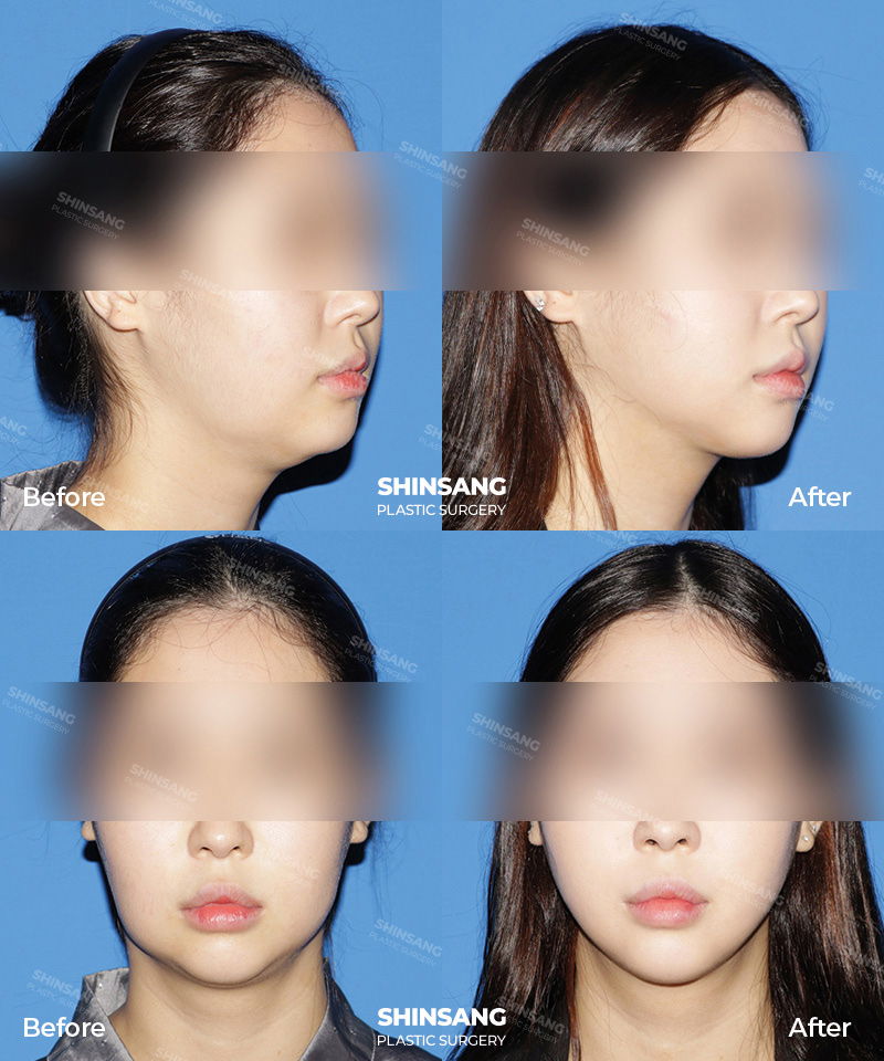 Double Chin Neck Lift Before And After Result At Sinsang Plastic Surgery In Korea