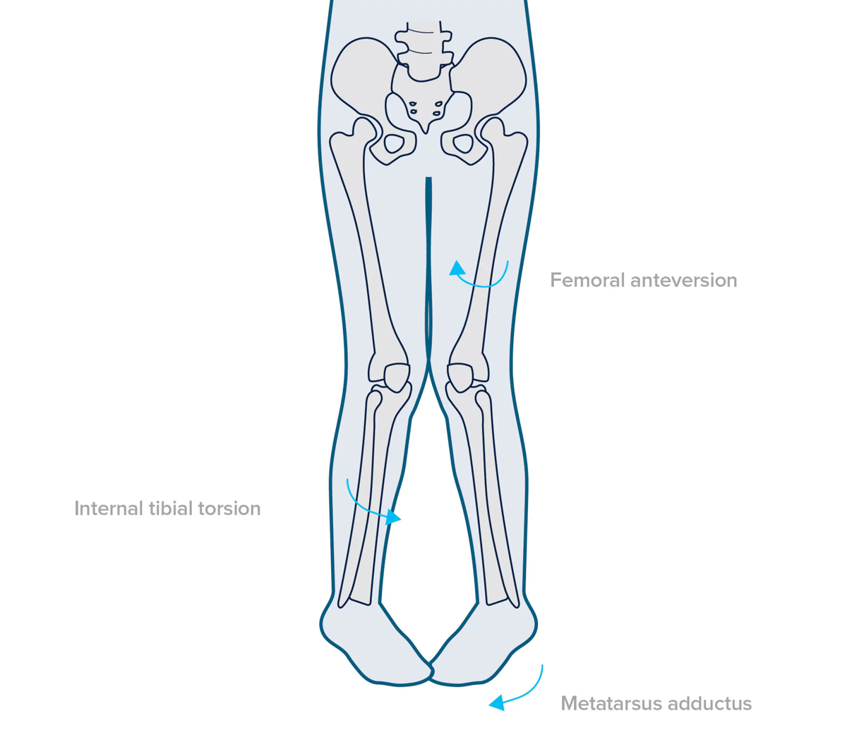 Intoeing gait — rotational profile of hip, tibia, and foot