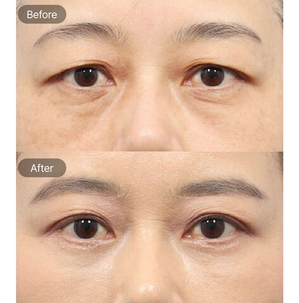 Brow Lift and Lower Blepharoplasty Before and After Results at 1MM Plastic Surgery in Korea for a More Youthful Eye Appearance