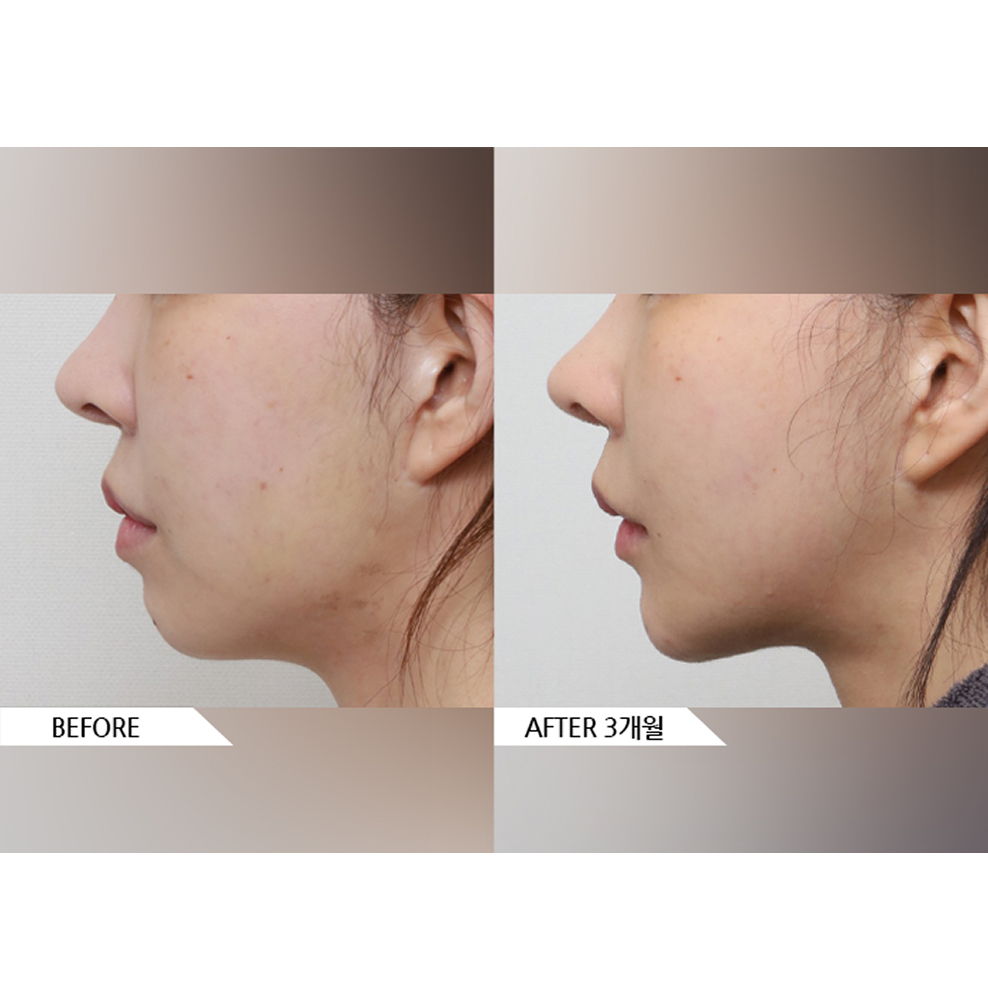 Before and after facial liposuction combined with thread lift showing improved jawline definition, reduced sagging, and tighter skin contour 3 months after treatment in Korea