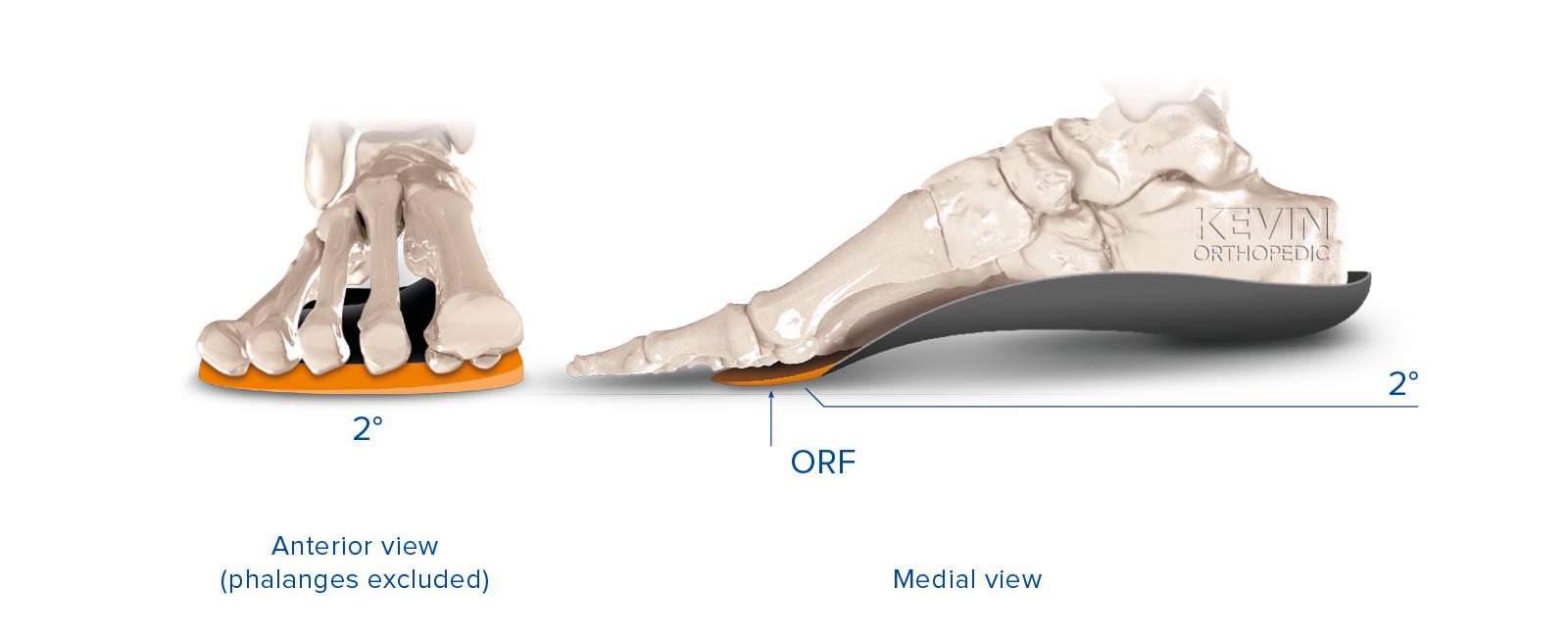 THE CLINIC GUIDE: PRONATION - Varus Metatarsal Wedge – Kevin Orthopedic ...