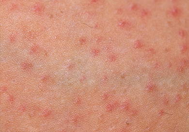 A picture of rashes on skin