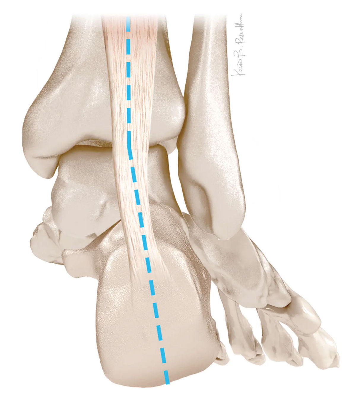 Adult acquired flatfoot — posterior tibial tendon and arch anatomy