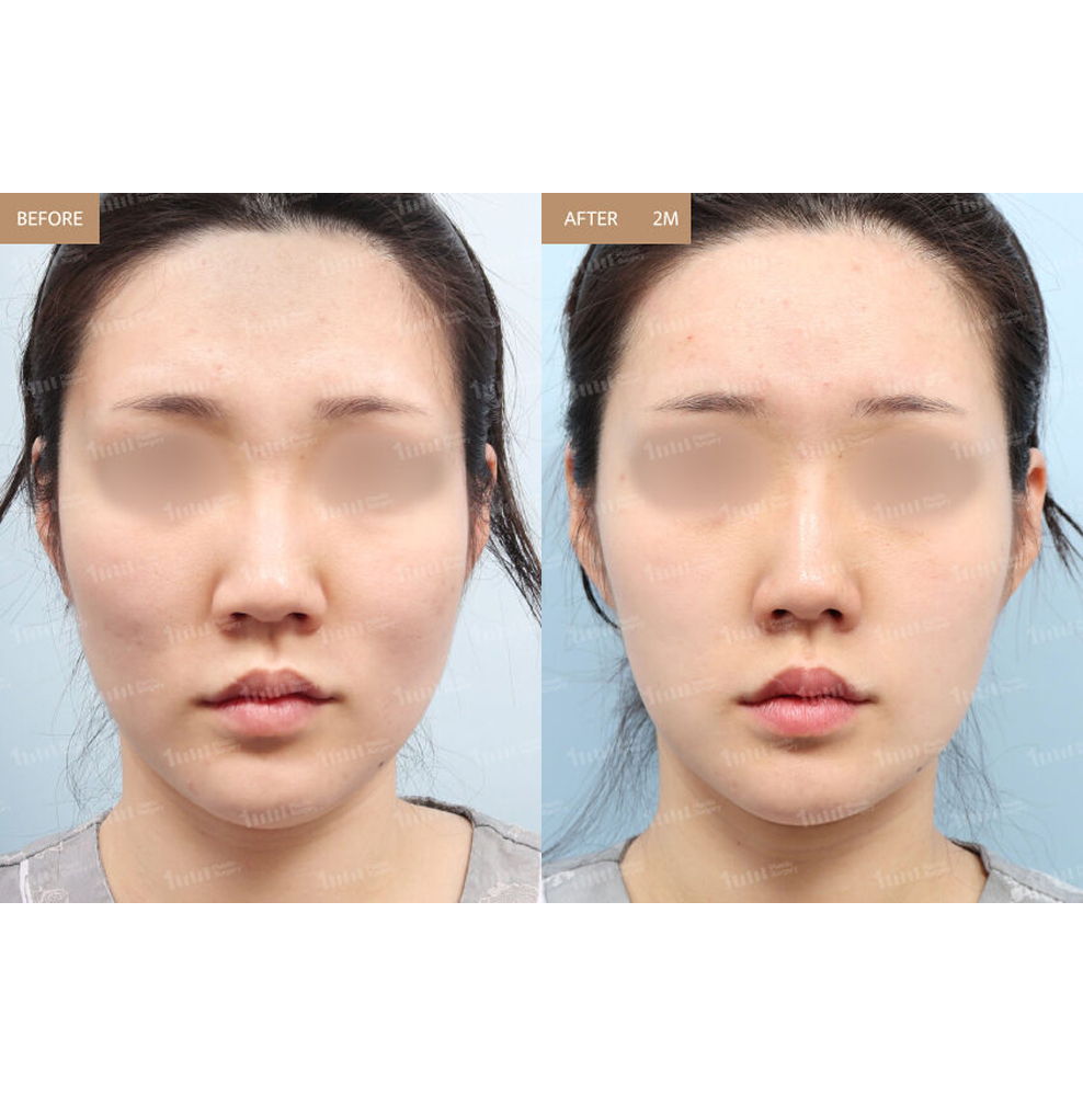 Full Face Fat Grafting Before and After Results at 1MM Plastic Surgery in Korea for Smooth and Natural Facial Volume Enhancement
