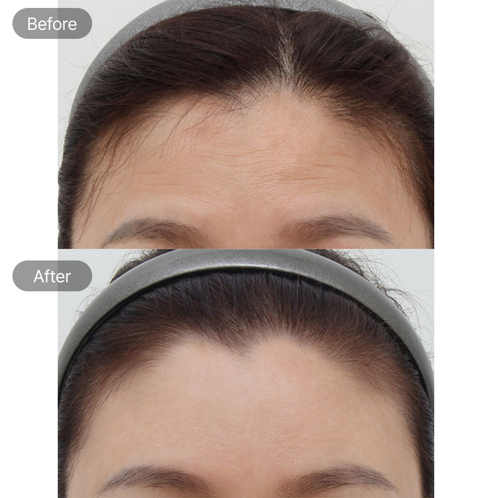 Forehead wrinkle treatment before and after results at Fresh Dr. Hong Plastic Surgery in Korea