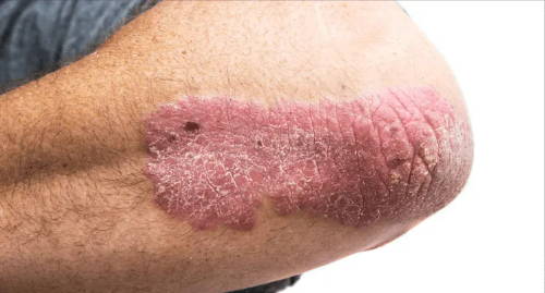 Éruption rouge et squameuse sur le coude d’une personne, typique du psoriasis sur une peau plus pâle