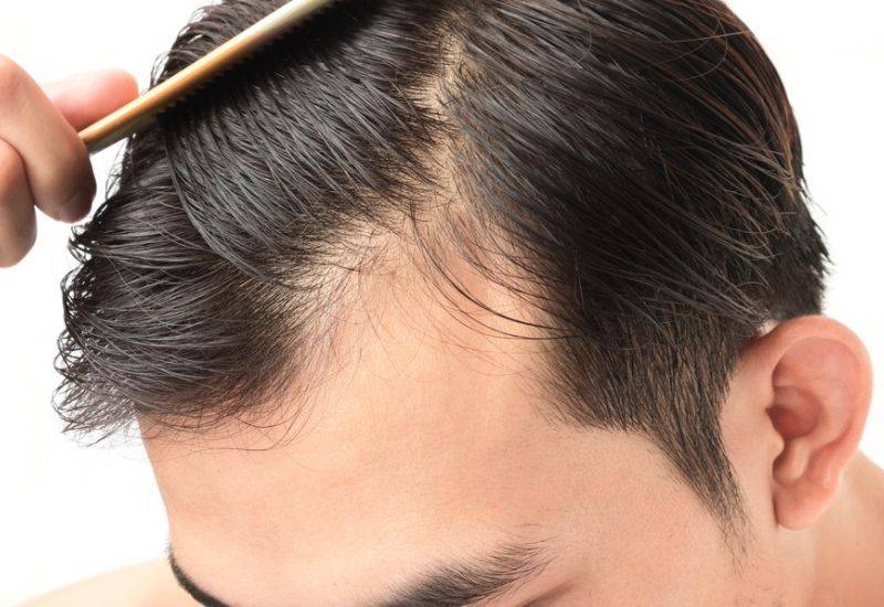 does minoxidil cause hair shedding