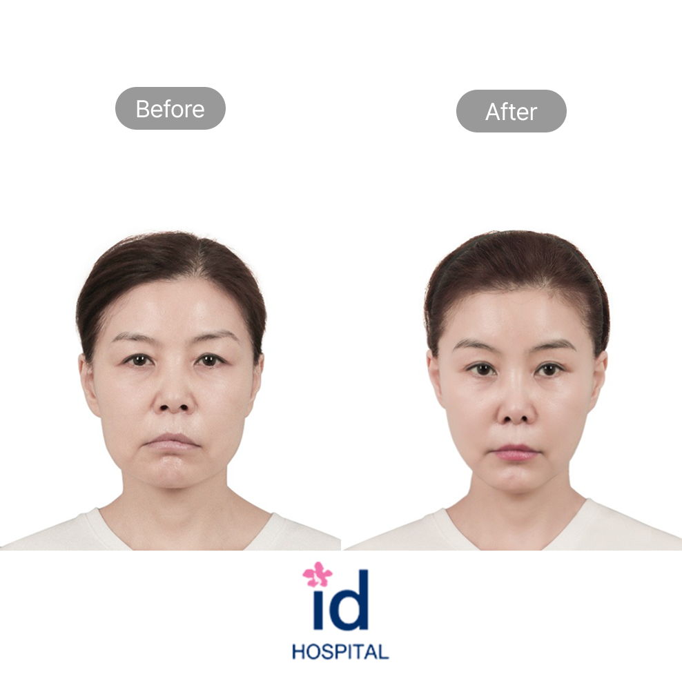 Middle Age Eye Reshaping and Eye Correction Before and After Result at ID Hospital