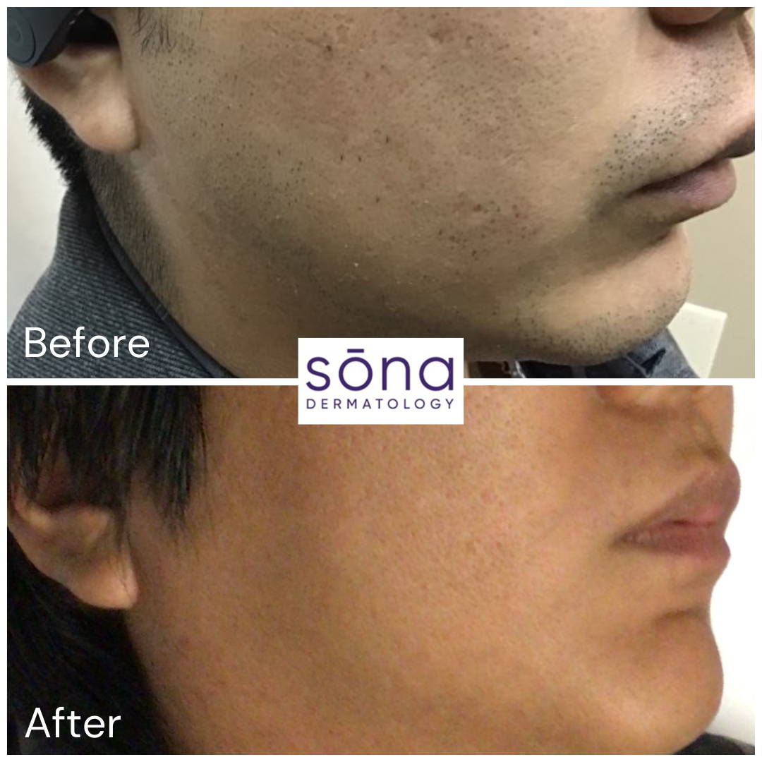 Sona Motus AY Laser Hair Removal Before & After 3