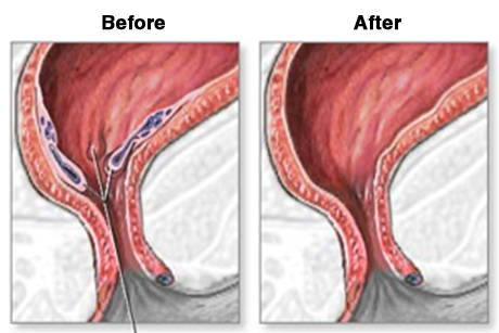 Photos avant et après d'un rectum