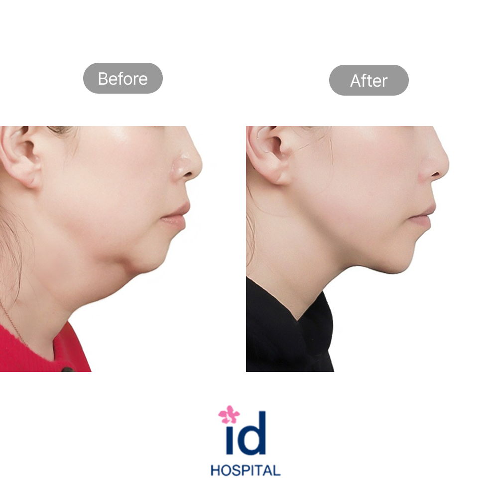 Double Chin, Bullfrog Neck, and Middle Age Lifting Before and After Result at ID Hospital