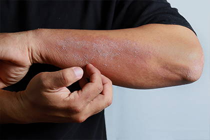 Una foto de un hombre rascándose el brazo