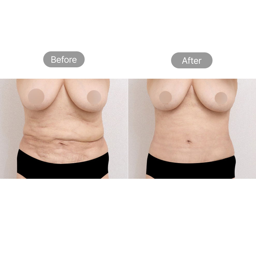 Tummy tuck and abdominal contouring before and after results at Fresh Dr. Hong in Korea