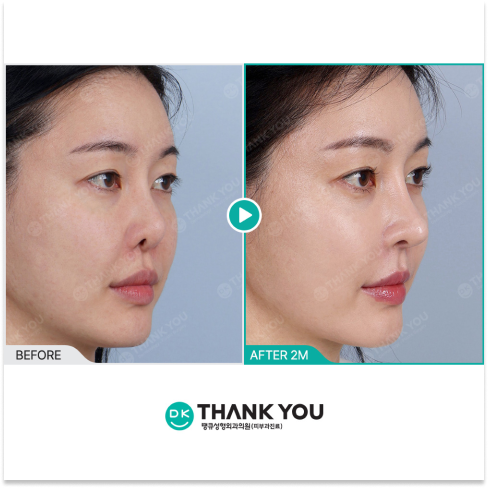 Before and After Results of Rejuran PDRN Injection for Korean Skin Booster Treatment and Glass Skin Improvement in Seoul