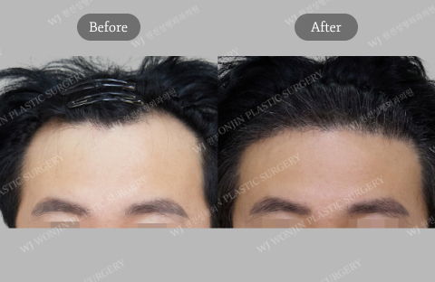 Male Plastic Surgery in Korea Featuring PRP and Exosome Hair Restoration for Natural Hairline Improvement
