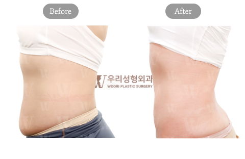 Abdominal Liposuction Before And After Results Related To Fat Removal Cost In Korea
