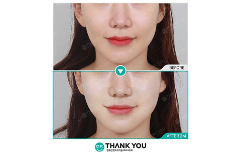 Before And After Review Image Of Thermage FLX 300 Shots Combined With Sculptra Filler At Thank You Plastic Surgery Clinic In Korea