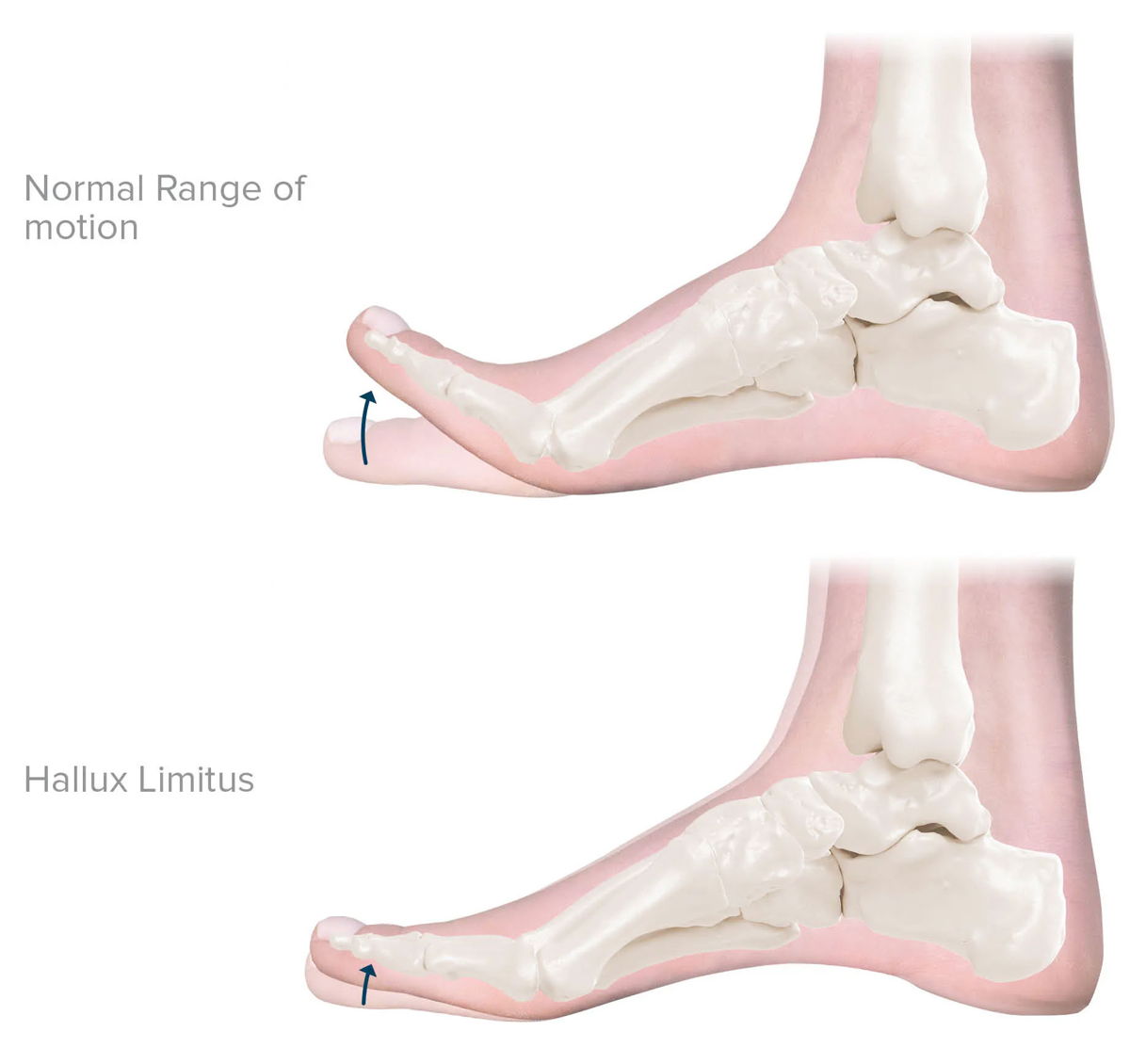 Hallux Limitus — first metatarsophalangeal joint anatomy