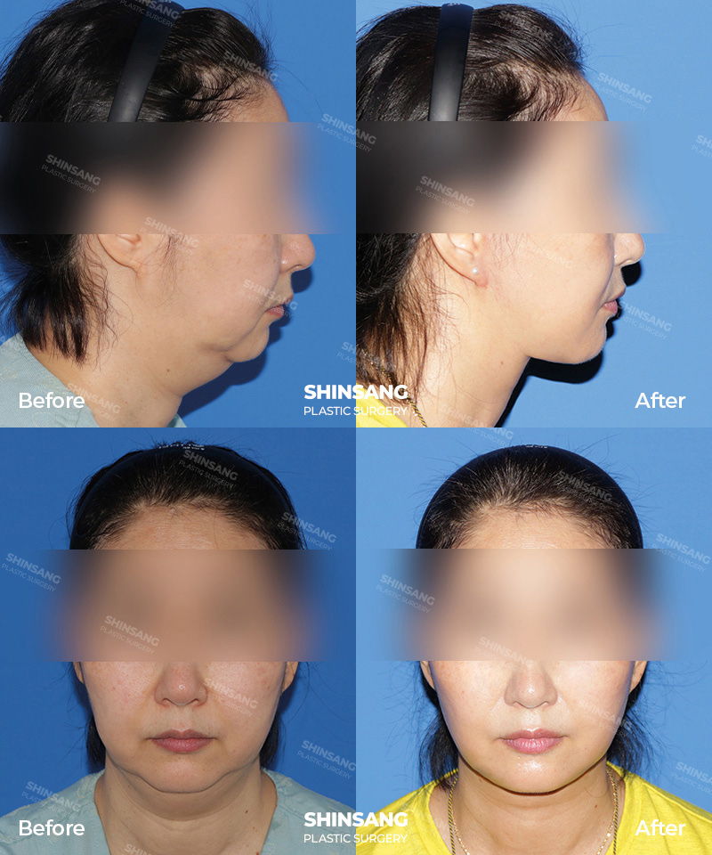 Toad Neck Reduction Before And After Result At Sinsang Plastic Surgery In Korea